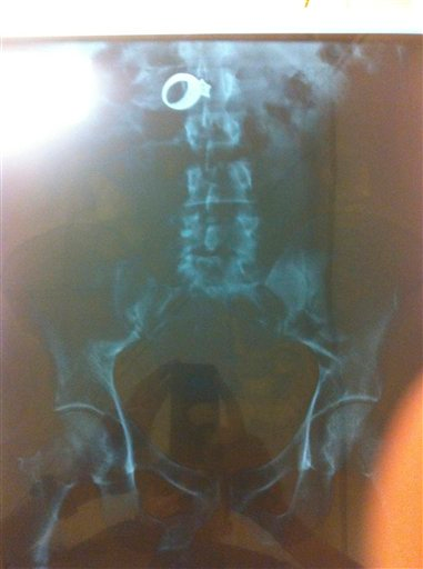 An x-ray reveals a diamond ring inside Wilfredo Gonzalez-Cruz that he allegedly stole from the home of a women.