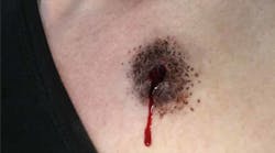 The effect of a bullet entry wound from the MasterCast line from Moulage Concepts Inc.